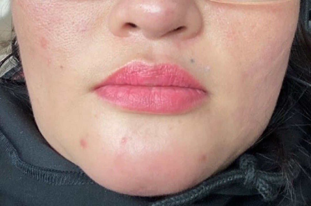 Tiêm filler cằm, một phụ nữ U40 bị chảy dịch mủ trong miệng